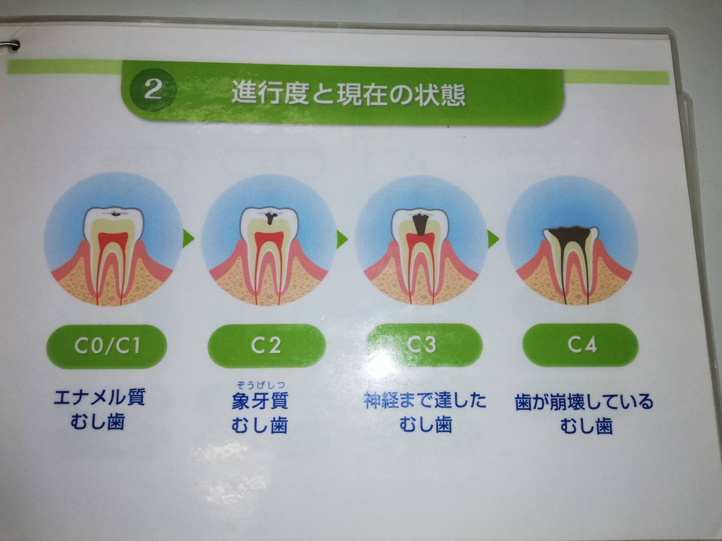 虫歯のステージ🦷