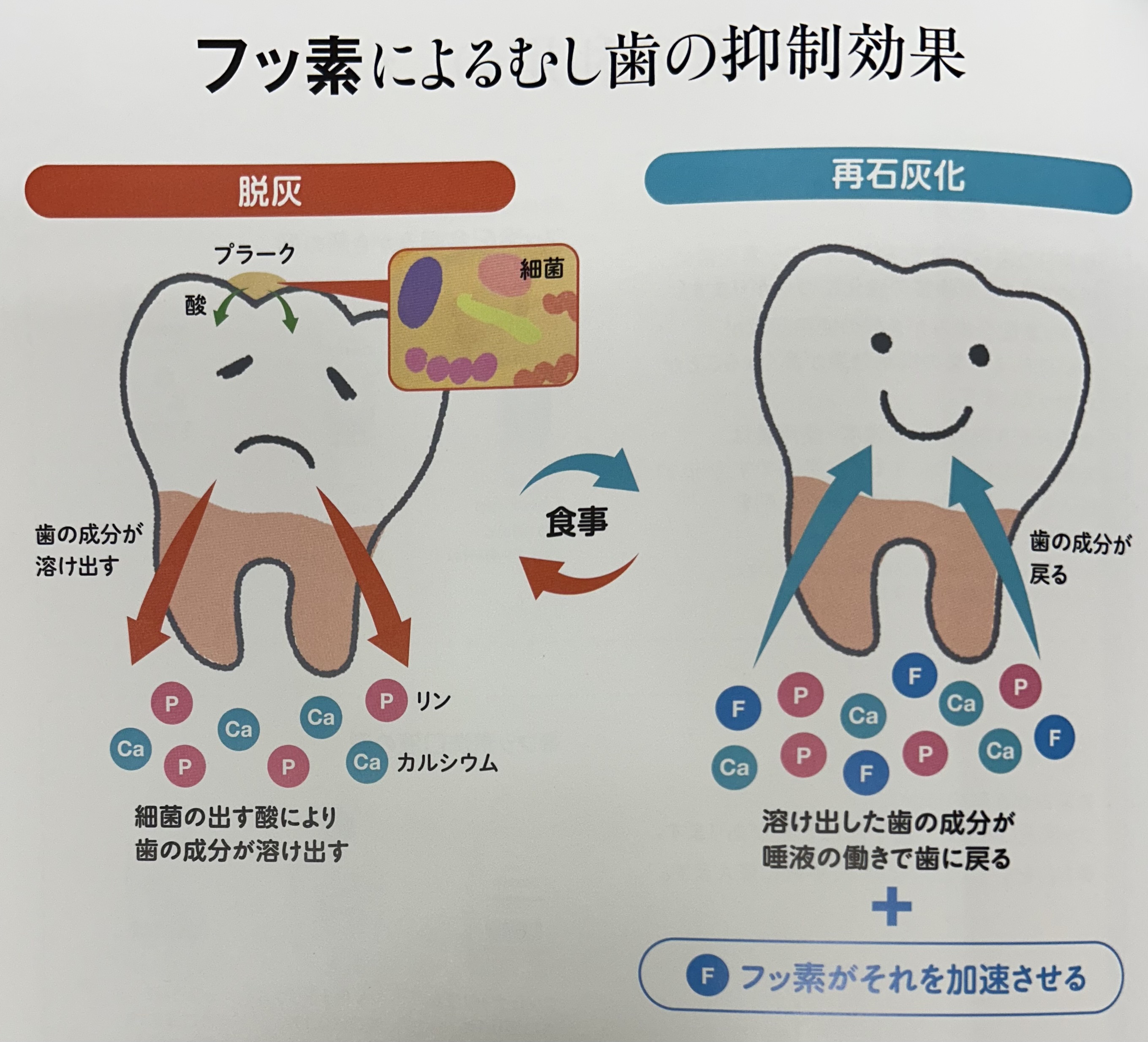 フッ素による虫歯予防🦷