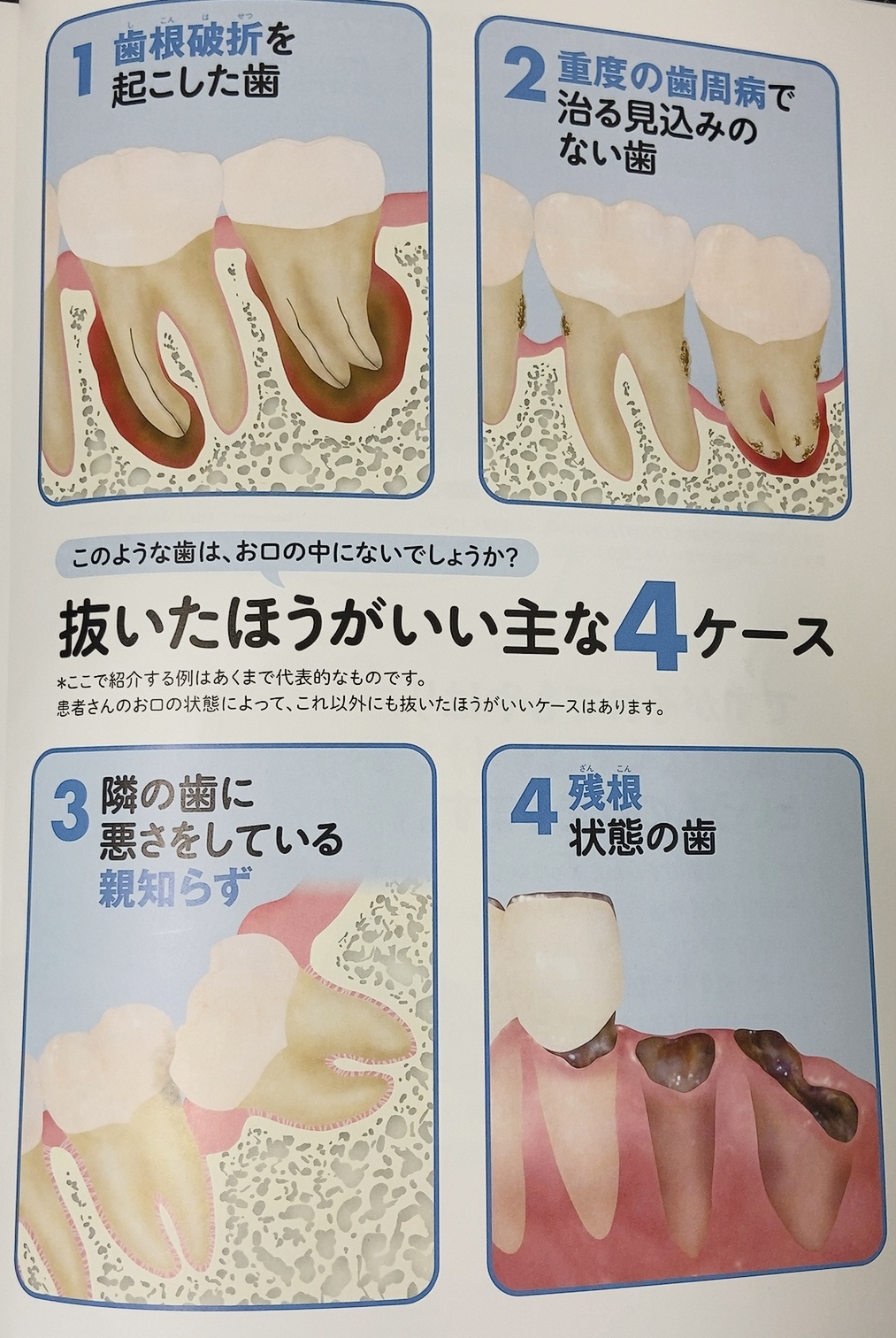 大切な歯⭐️時には抜いた方がいい時があります😭