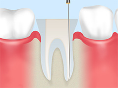 重度のむし歯は「根菅治療」で対応
